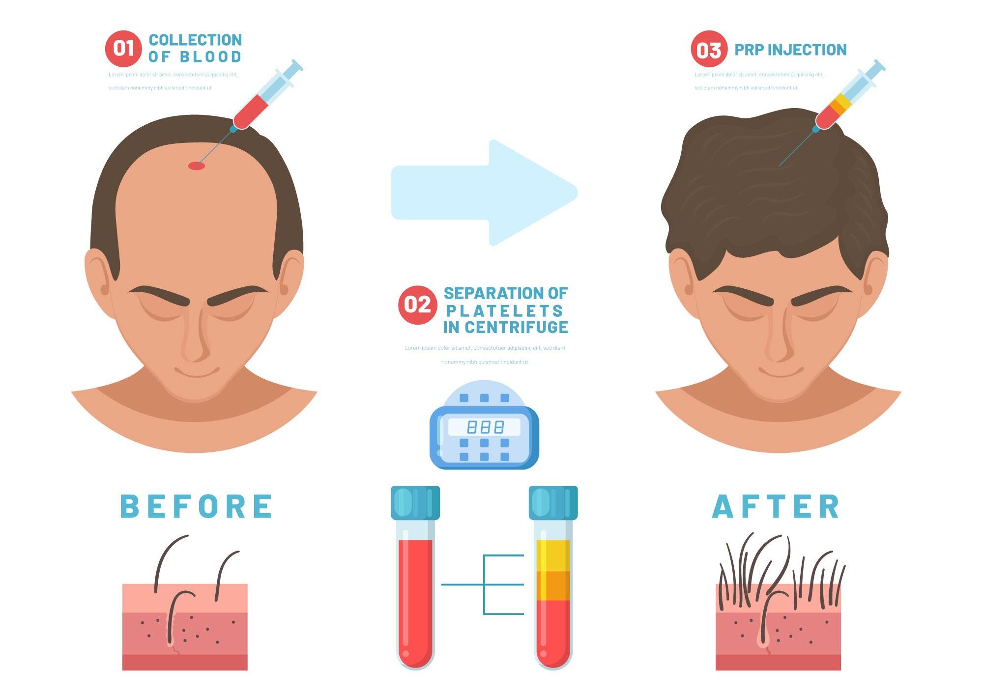 How PRP Works: The Science Behind Hair Regrowth